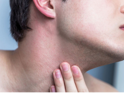 Ini Cara Atasi Luka Bakar Setelah Bercukur atau Razor Burn